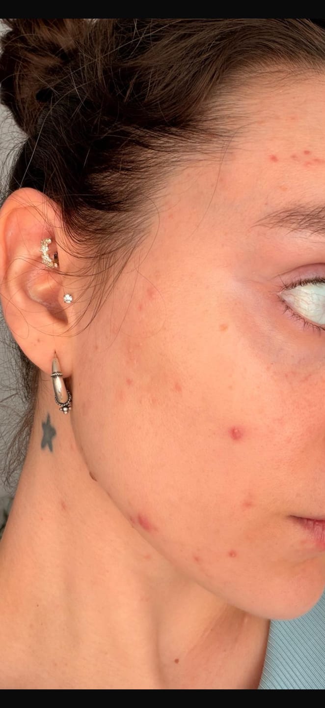 Customer photo review of A CONTROL - ACNÉ HORMONAL & RESISTENCIA A LA INSULINA