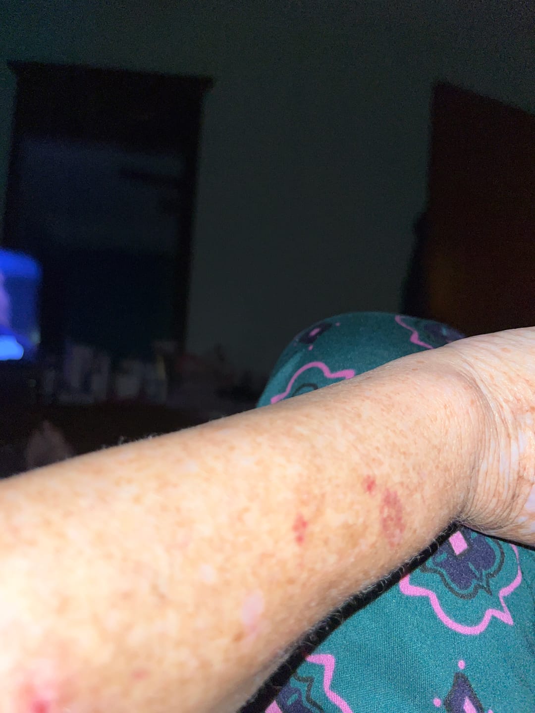 Customer photo review of Purpurex® Daily Supplement for Bruising 60 Capsules