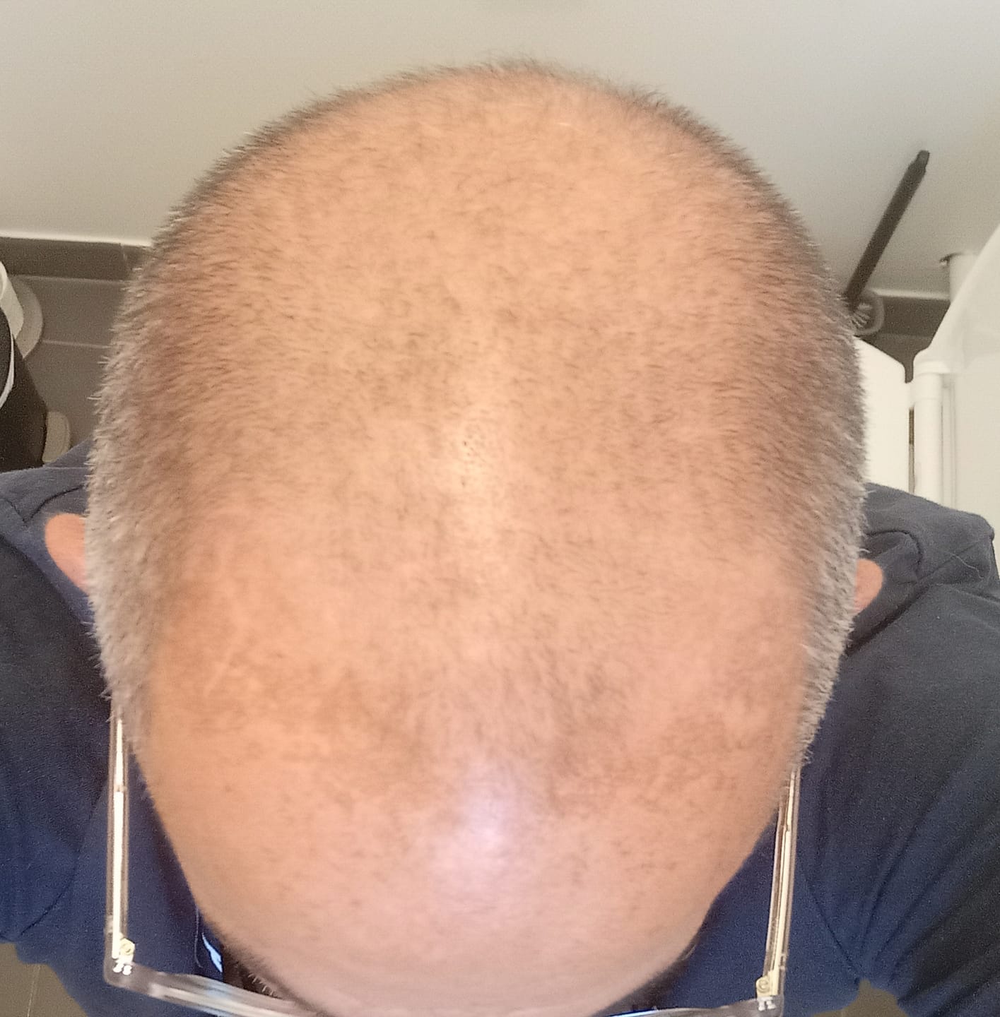 Customer photo review of Sérum au Redensyl Activateur de Pousse Cheveux