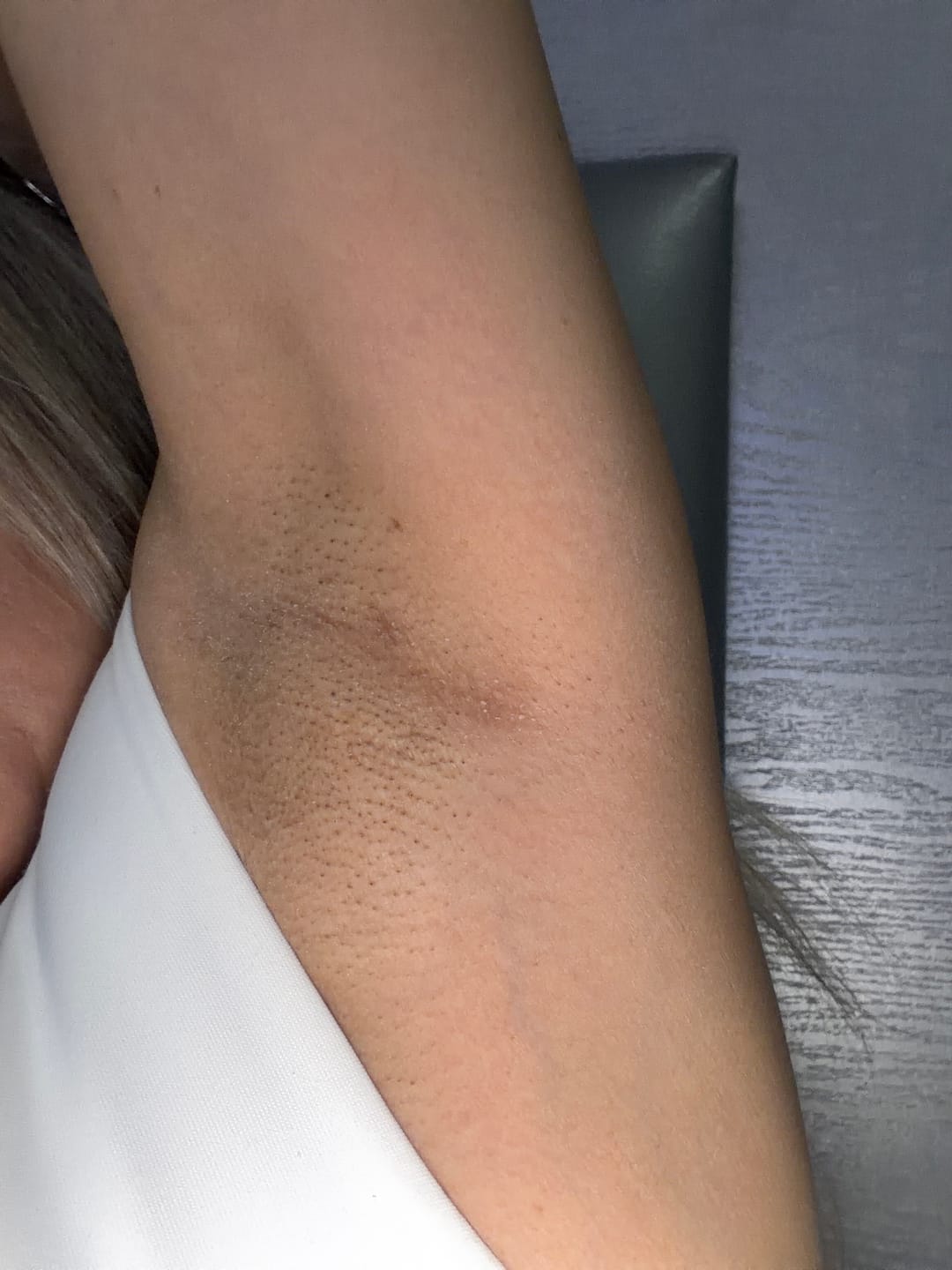 Customer photo review of Tratamiento Aclarante Skinglow