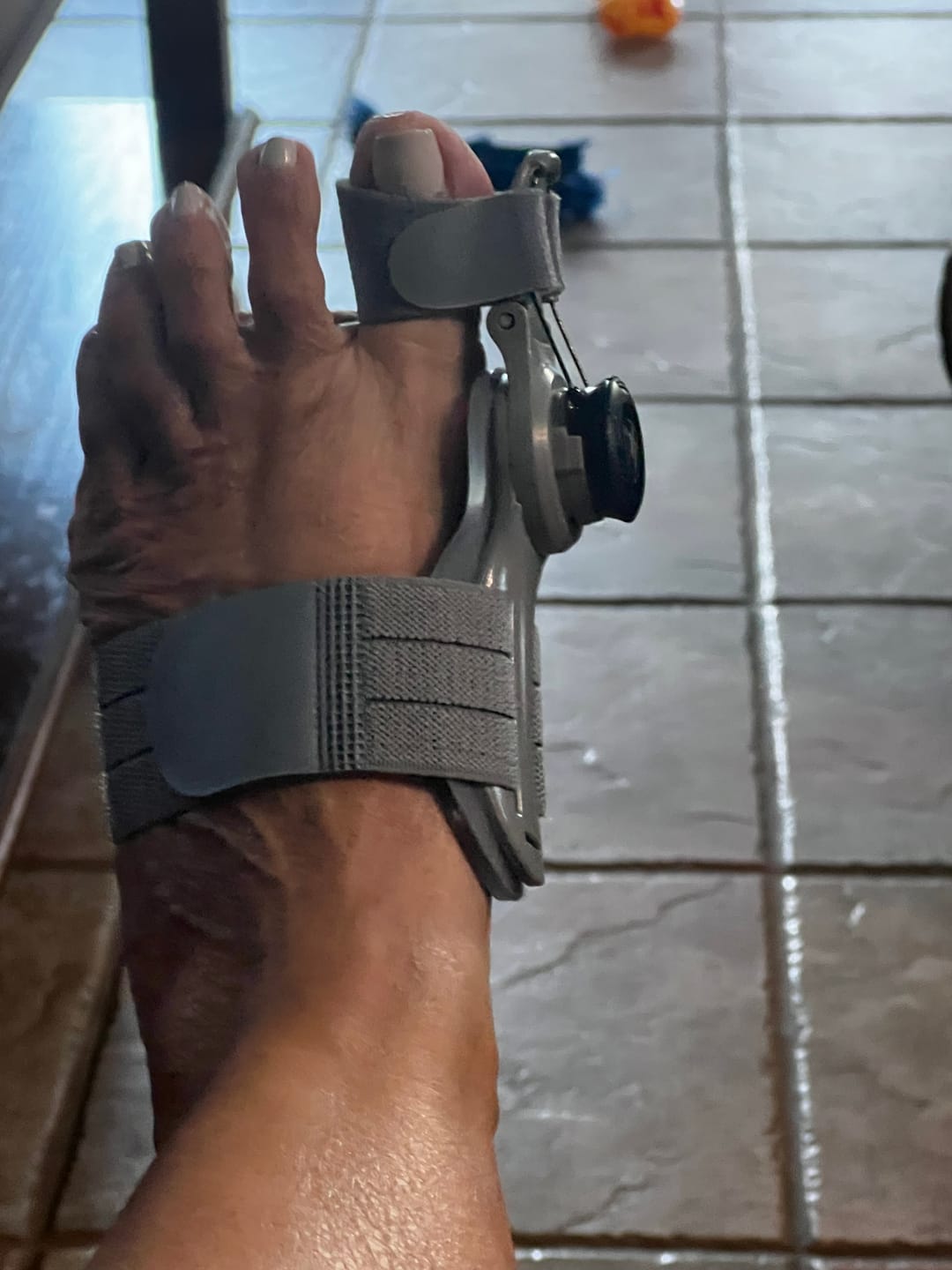 Customer photo review of Treatmedy™ Bunion Fix