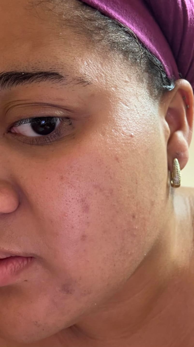 Customer photo review of 1% Kojic Acid Dark Spot Treatment for Brighter, Even-Looking Skin