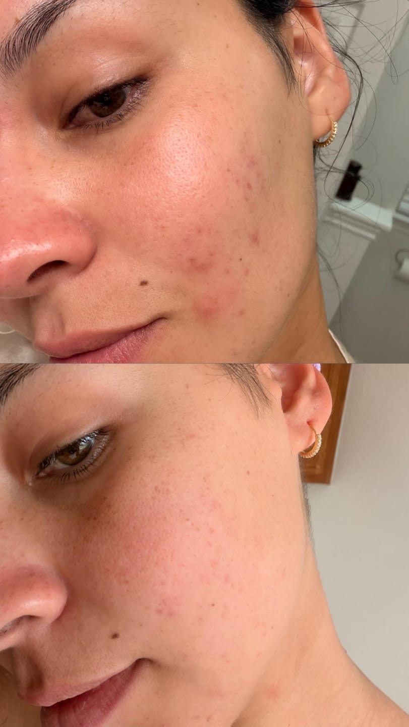 Customer photo review of 1% Kojic Acid Dark Spot Treatment for Brighter, Even-Looking Skin