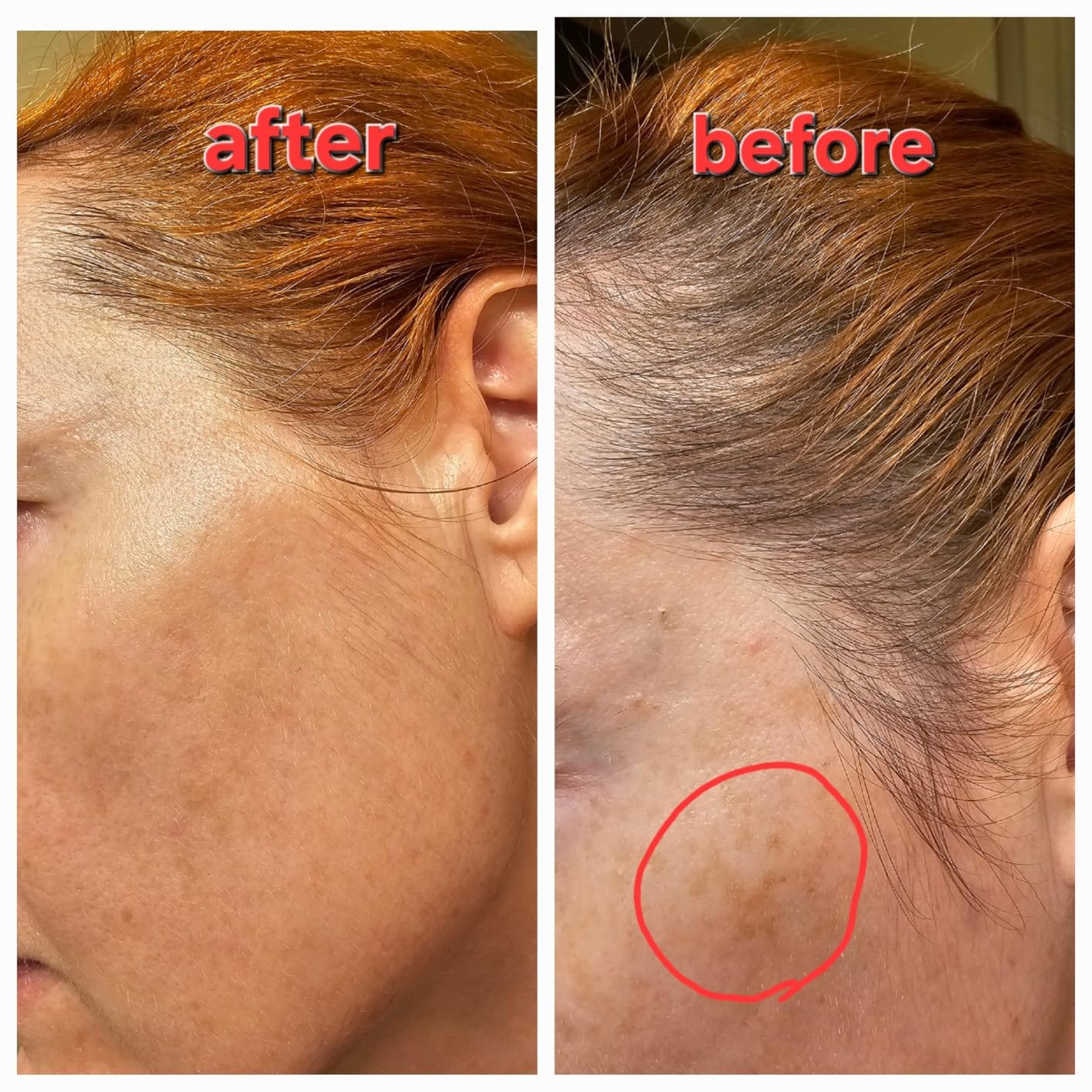 Customer photo review of 1% Kojic Acid Dark Spot Treatment for Brighter, Even-Looking Skin