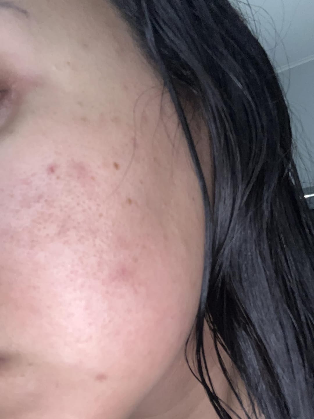 Customer photo review of 1% Kojic Acid Dark Spot Treatment for Brighter, Even-Looking Skin