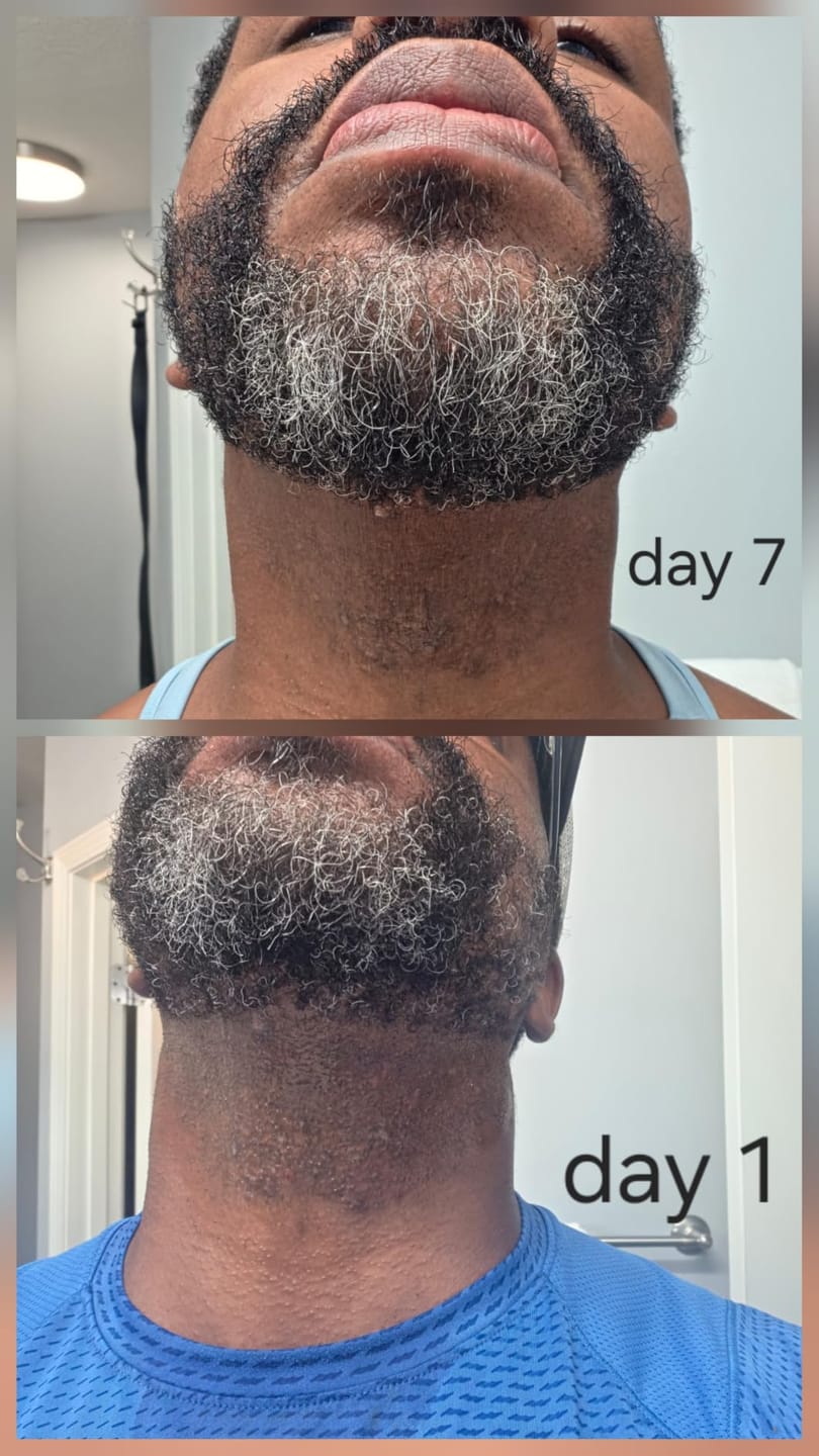 Customer photo review of 1% Kojic Acid Dark Spot Treatment for Brighter, Even-Looking Skin
