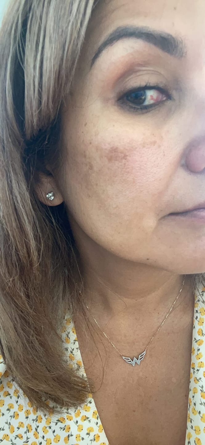 Customer photo review of 1% Kojic Acid Dark Spot Treatment for Brighter, Even-Looking Skin