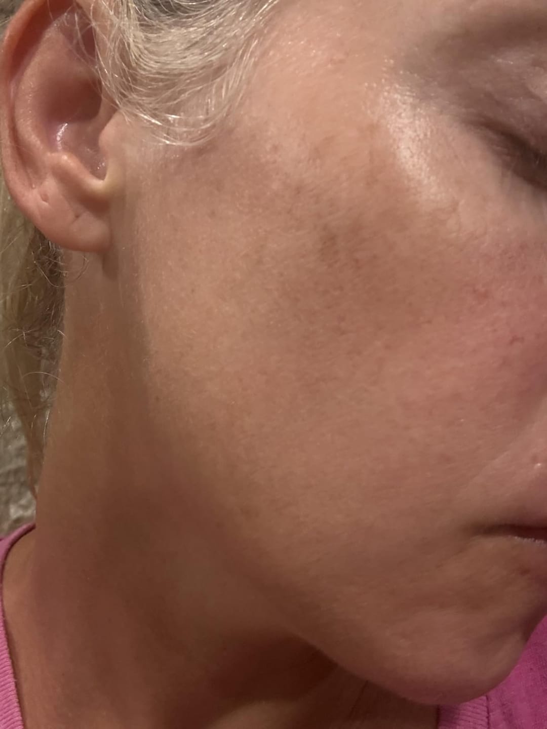 Customer photo review of 1% Kojic Acid Dark Spot Treatment for Brighter, Even-Looking Skin
