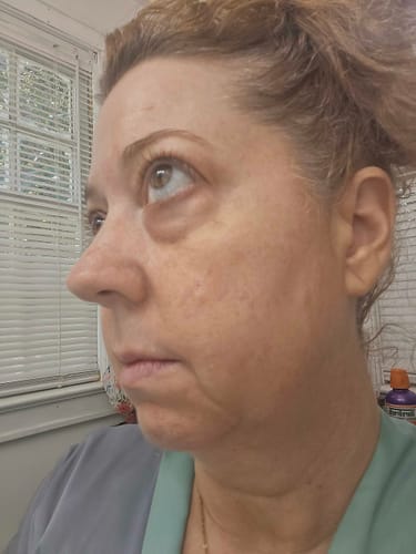 Reviewer's side profile showing skin texture before using The Micro Infusion System.