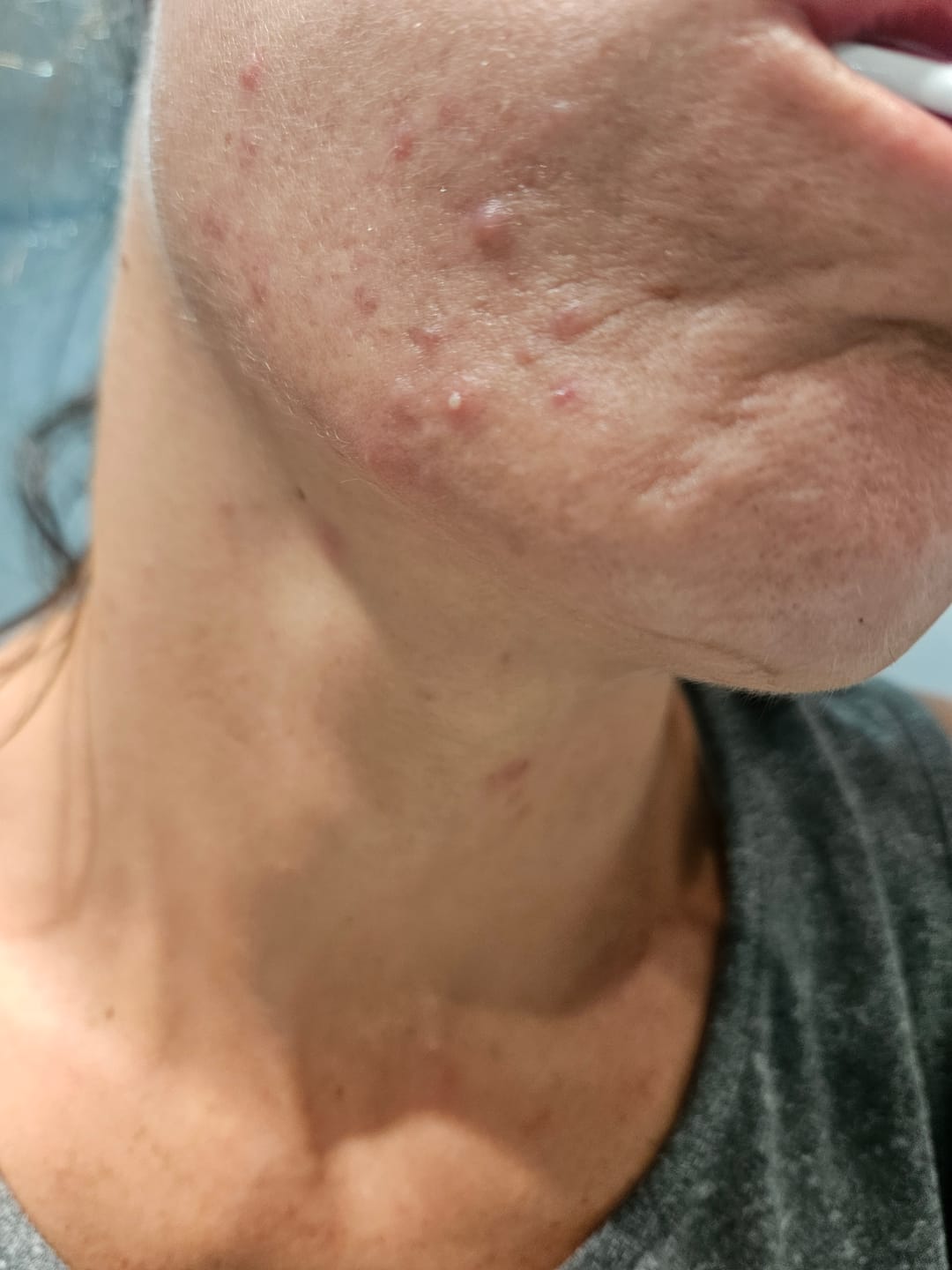 Customer photo review of A CONTROL - ACNÉ HORMONAL & RESISTENCIA A LA INSULINA