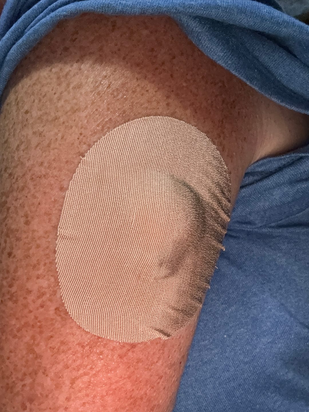 Customer photo review of Skin Grip Original - Medtronic Guardian/Enlite Adhesive Patches