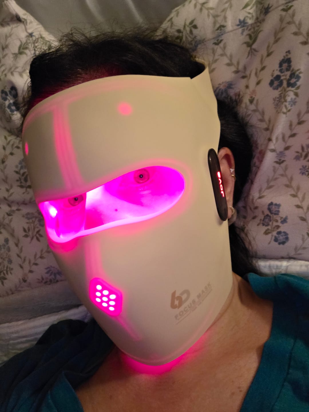 Customer photo review of JOVS 6D Laser & EMS Anti-Aging Therapy Mask