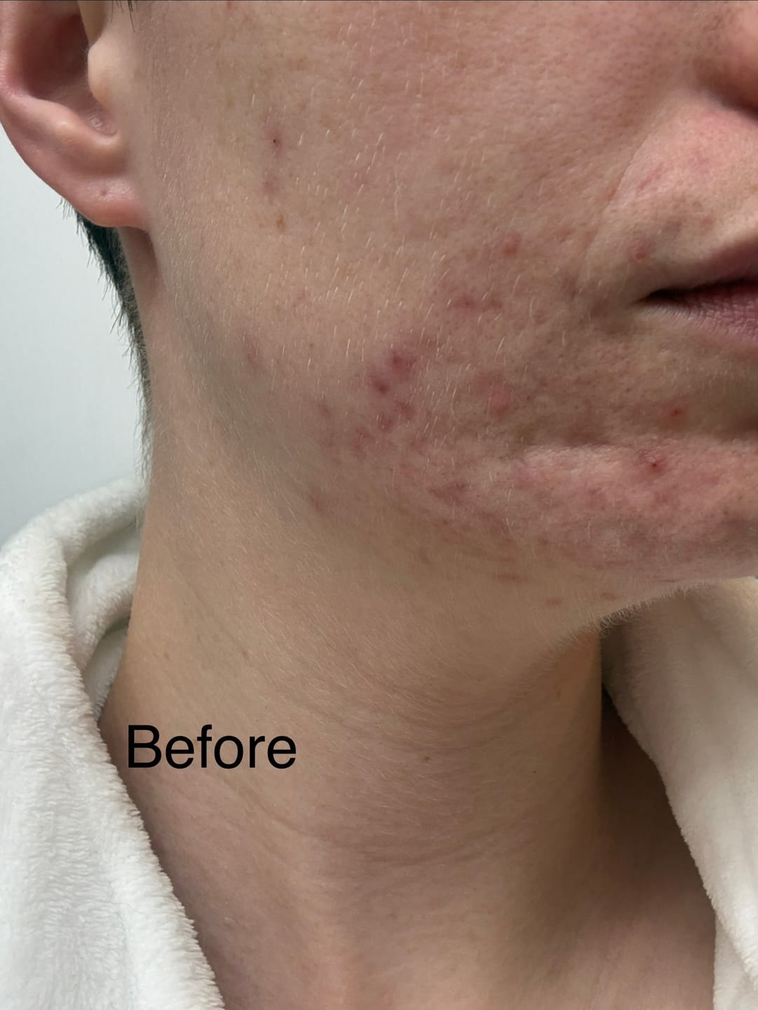 Customer photo review of BeautyPro 2.0 - High Frequency Wand