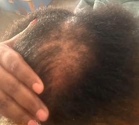 Customer photo review of CrownBloom™ Scalp Care