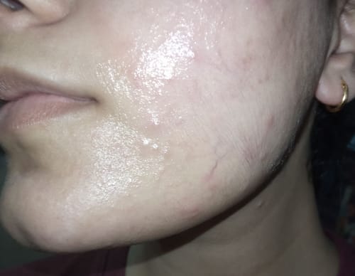 Reviewer's face showing skin irritation and texture after using the Lip Pigmentation Cream & Facewash Bundle