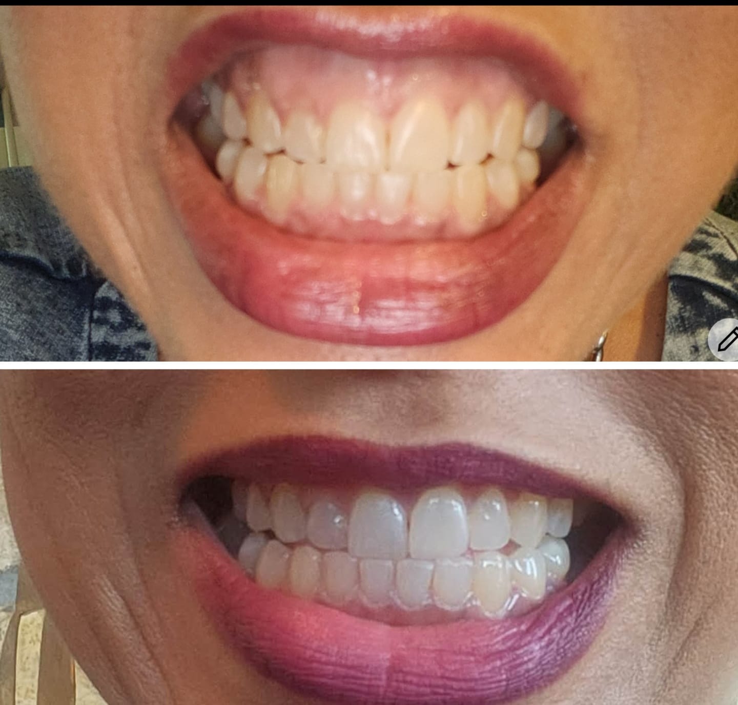 Customer photo review of TEETH WHITENING KIT