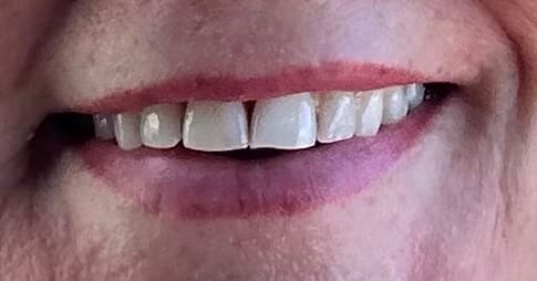 Customer photo review of Teeth Whitening Starter Bundle
