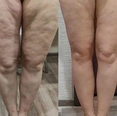 Customer photo review of TERSA™ — Masajeador Rotatorio Anticelulitis y Drenaje Linfático