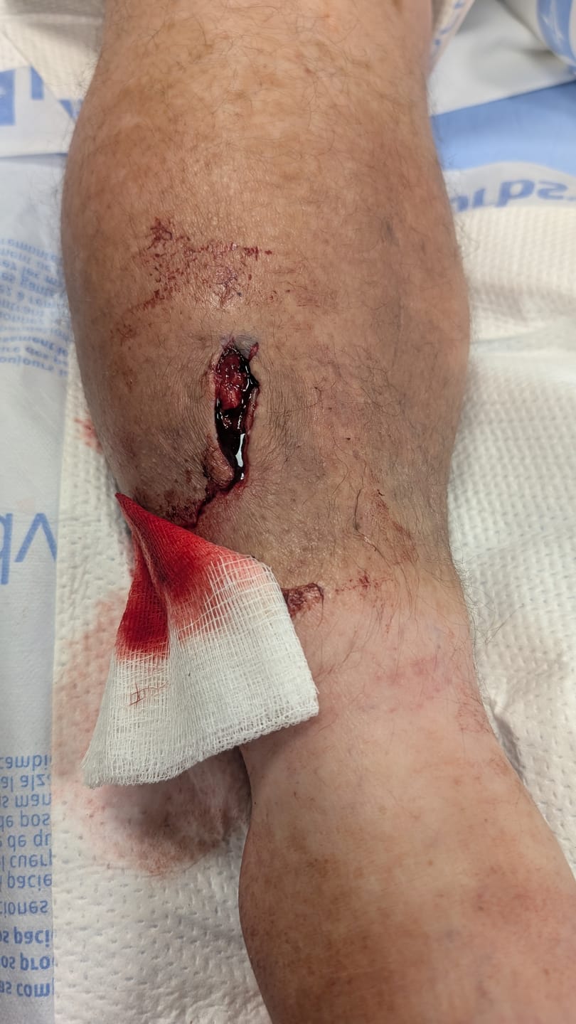 Customer photo review of Israeli Bandage