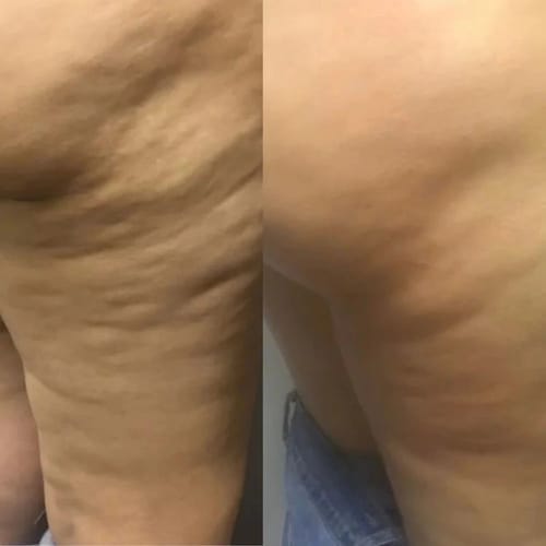 Customer photo review of TERSA™ — Masajeador Rotatorio Anticelulitis y Drenaje Linfático