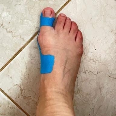 Customer photo review of AlluxTape™ - Cerotto Correttivo per Alluce Valgo e Cipolla al Piede