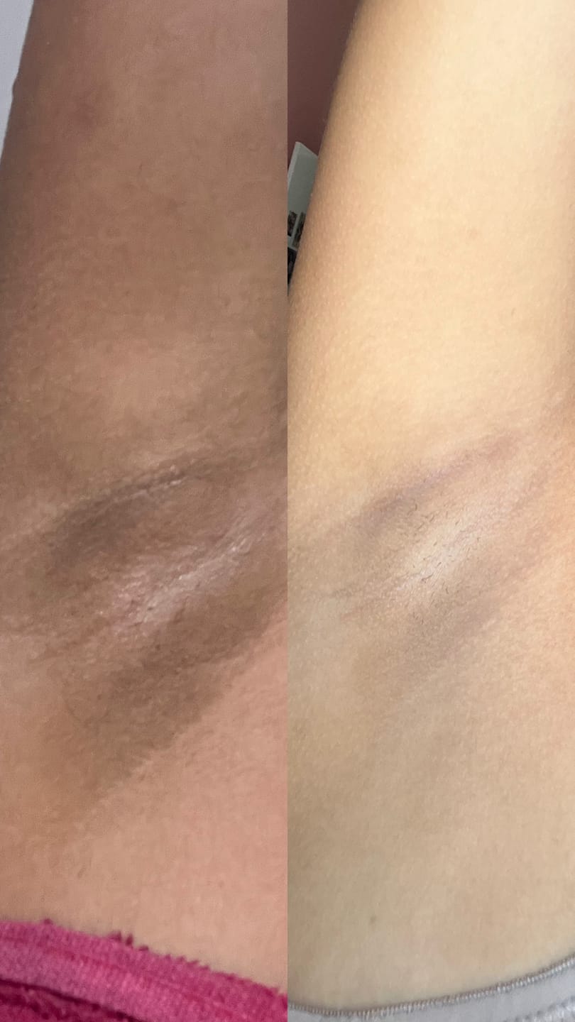 Customer photo review of Creme Clareador de Manchas – Melasma, Axilas, Virilha, Áreas Íntimas, Rosto e Corpo