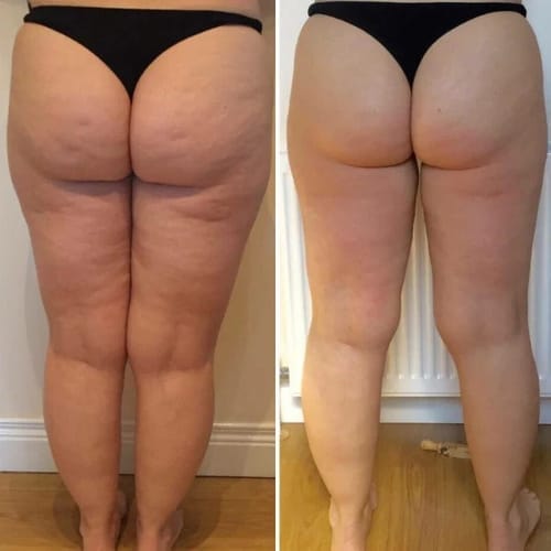 Customer photo review of TERSA™ — Masajeador Rotatorio Anticelulitis y Drenaje Linfático