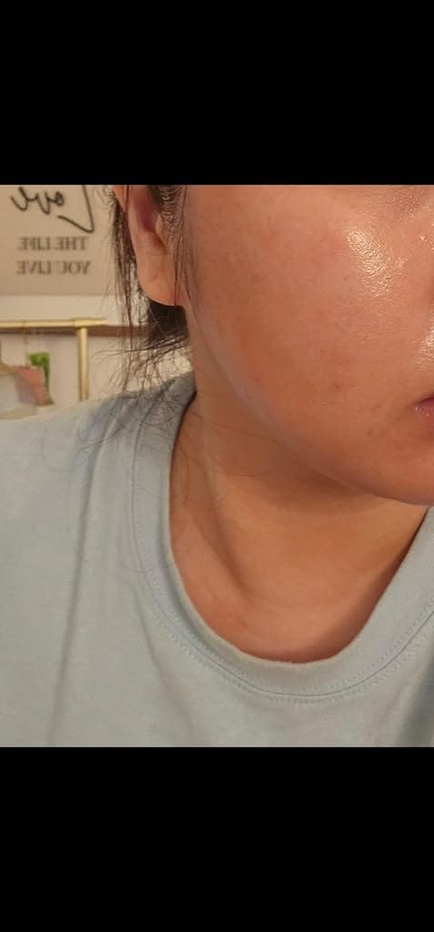 Customer photo review of VT COSMETICS CICA Reedle Shot 300