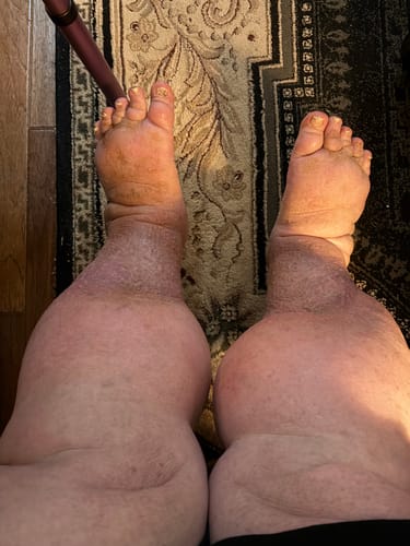 Customer photo review of Beltwell® Calf Compression Wrap