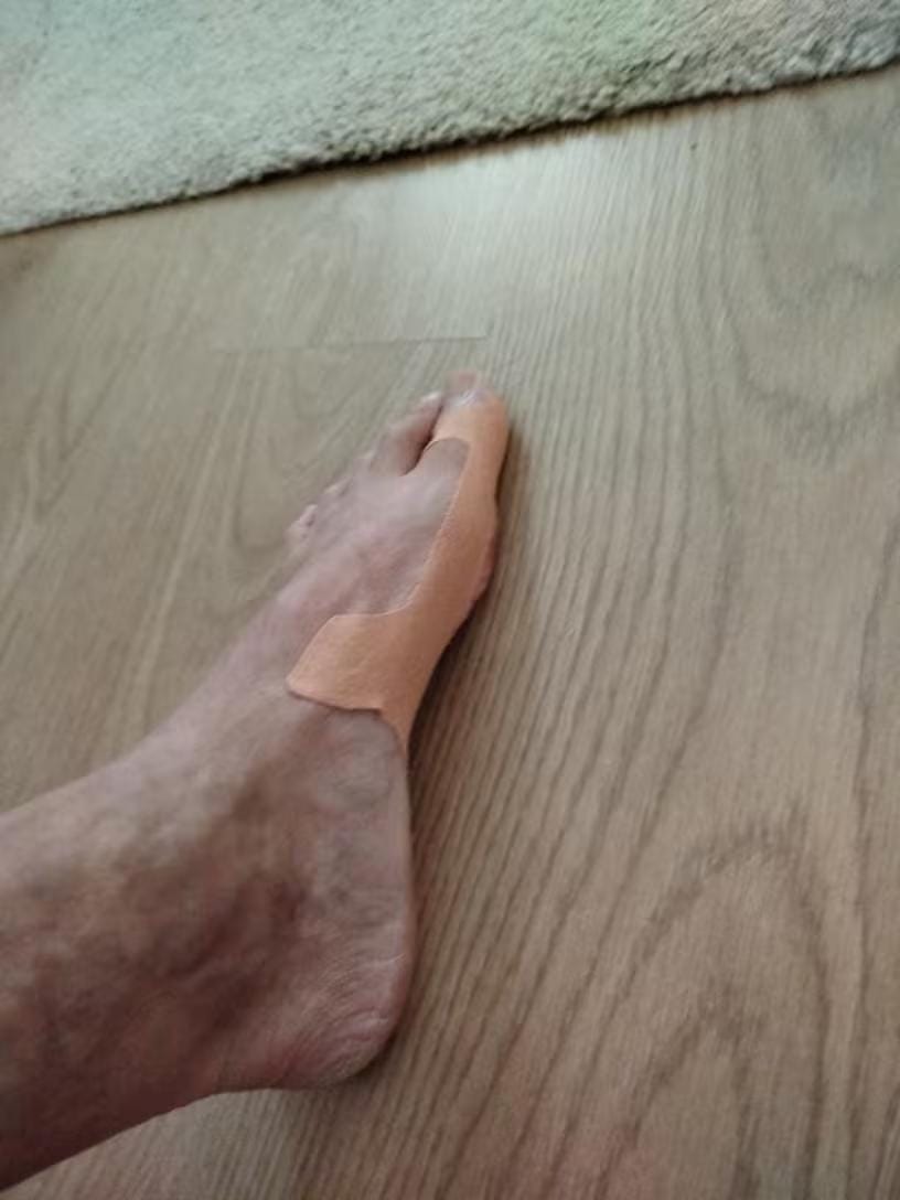 Customer photo review of AlluxTape™ - Cerotto Correttivo per Alluce Valgo e Cipolla al Piede