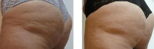 Customer photo review of TERSA™ — Masajeador Rotatorio Anticelulitis y Drenaje Linfático