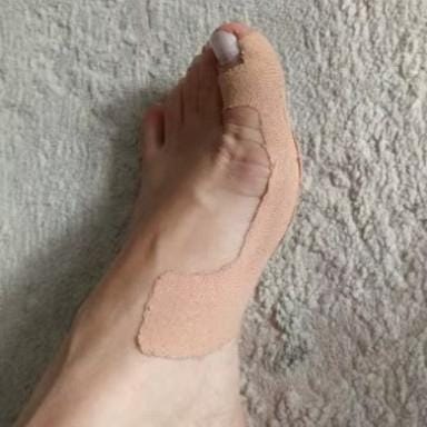 Customer photo review of AlluxTape™ - Cerotto Correttivo per Alluce Valgo e Cipolla al Piede