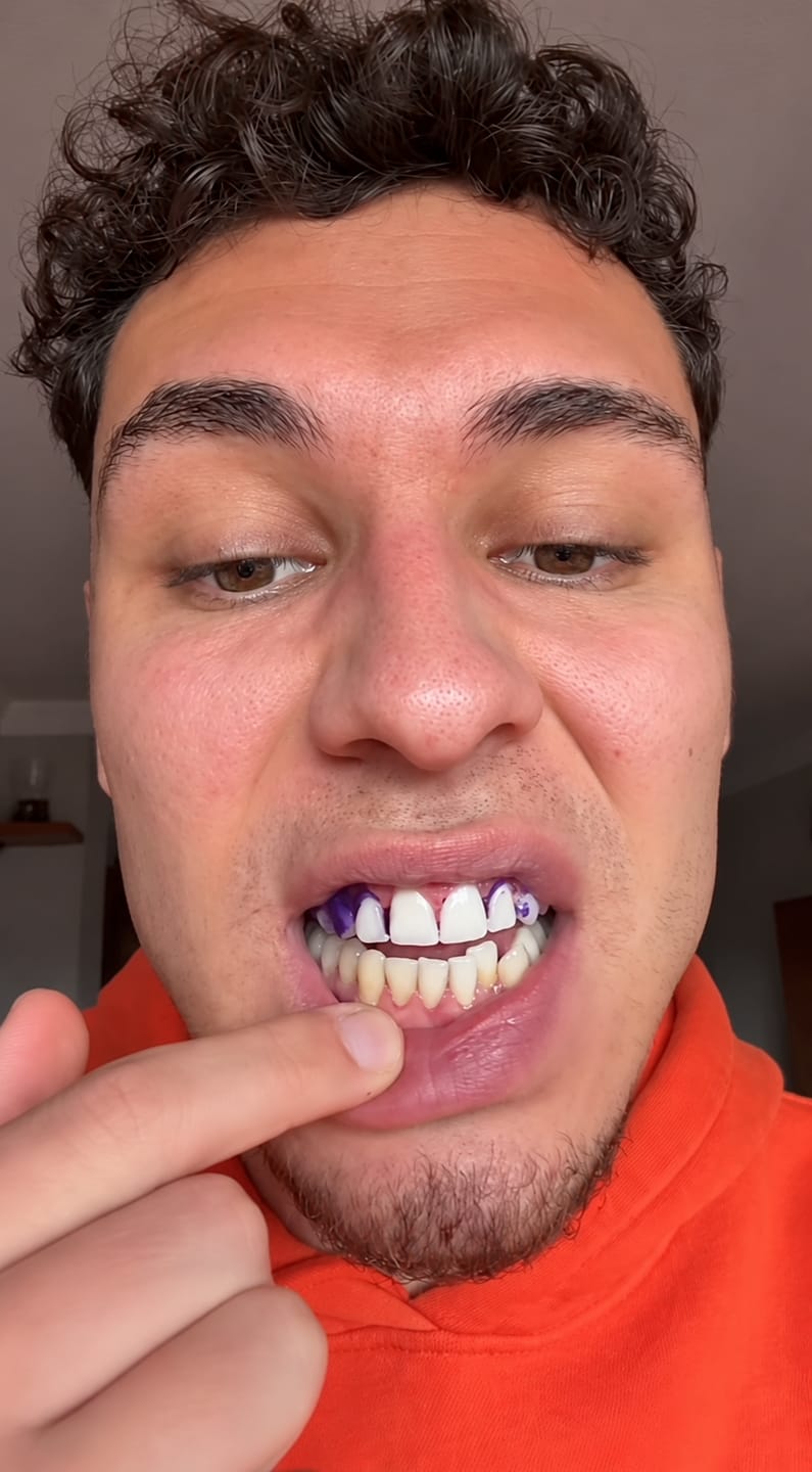 Customer photo review of CLUXO®—Blanqueador Dental V34