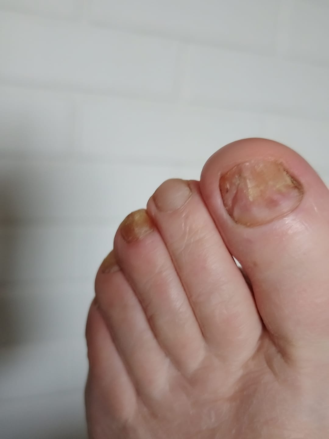 Customer photo review of MyCurePro® · Elimina hongos en pies y manos · 7 días