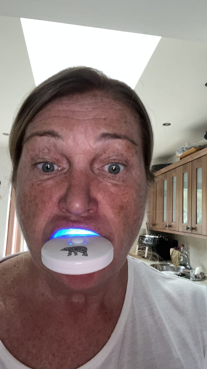 Customer photo review of Teeth Whitening Kit