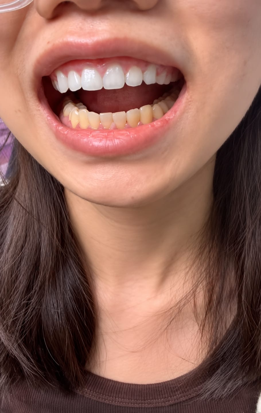 Customer photo review of CLUXO®—Blanqueador Dental V34