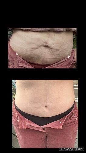 Customer photo review of Corpela® Reafirmante Densificante Piel Abdominal