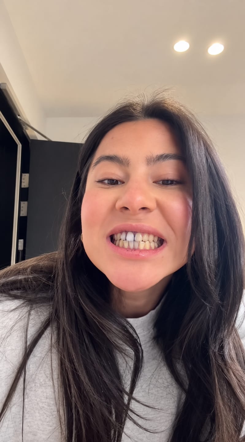 Customer photo review of CLUXO®—Blanqueador Dental V34