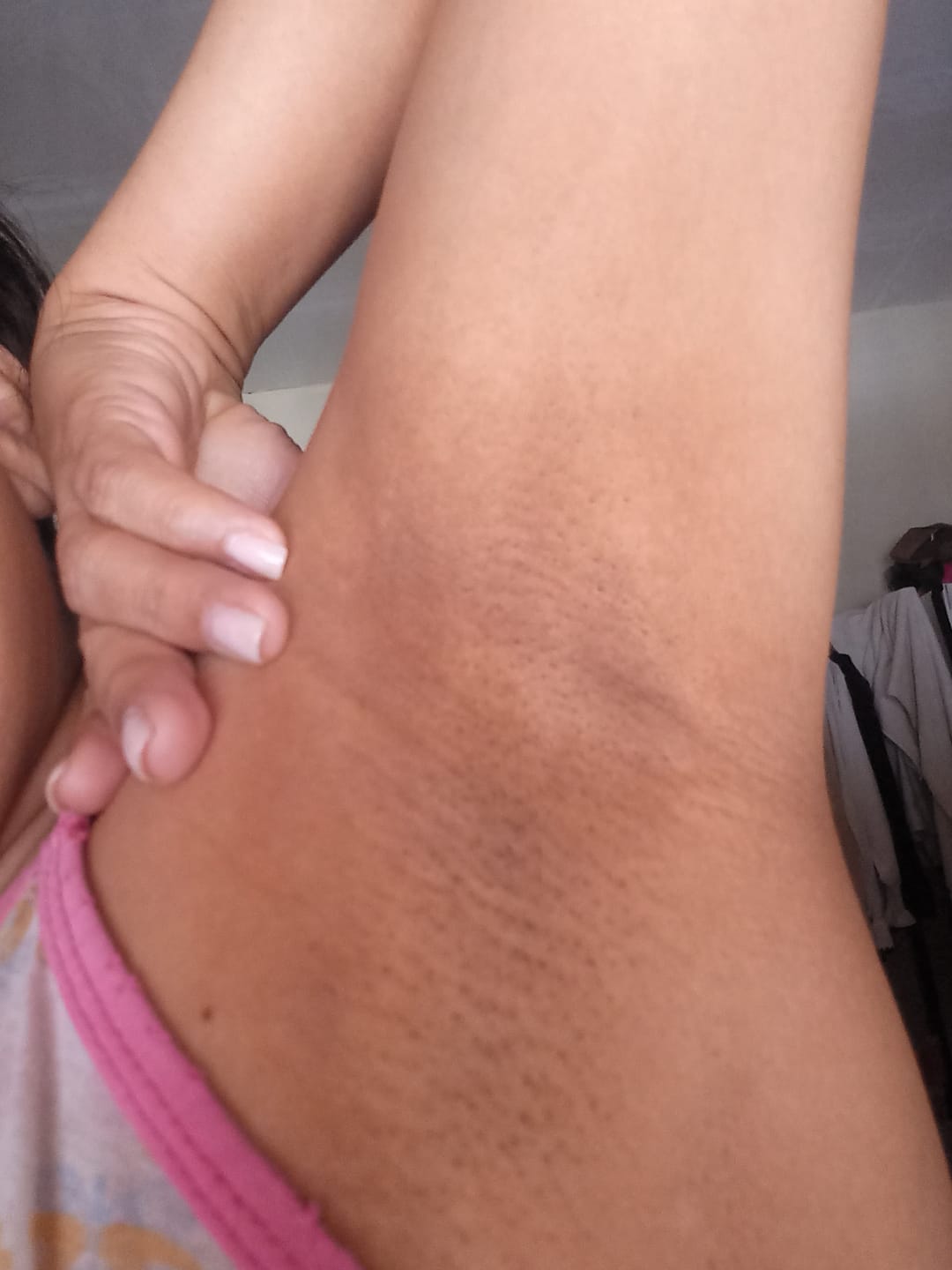 Customer photo review of Creme Clareador de Manchas – Melasma, Axilas, Virilha, Áreas Íntimas, Rosto e Corpo