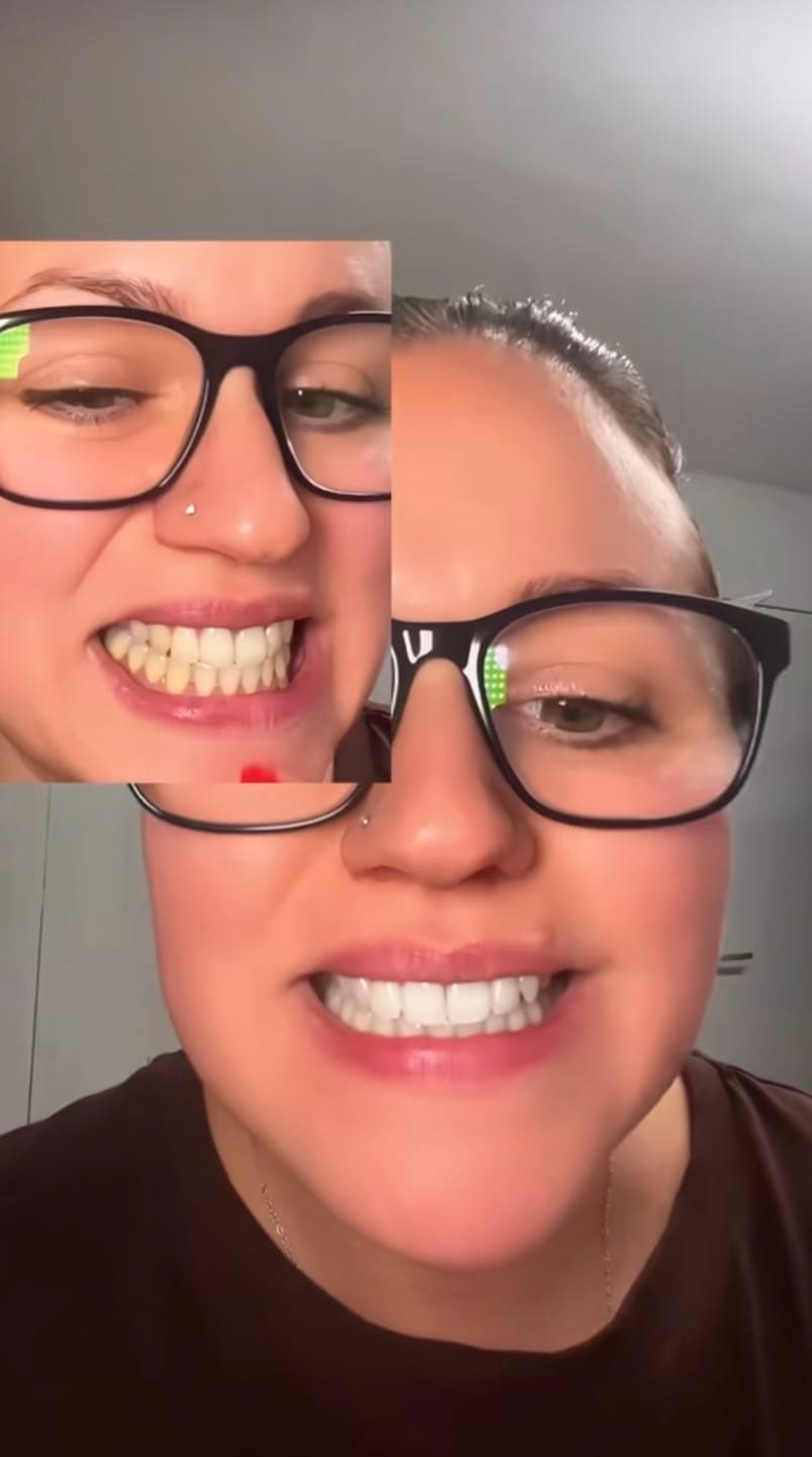 Customer photo review of CLUXO®—Blanqueador Dental V34