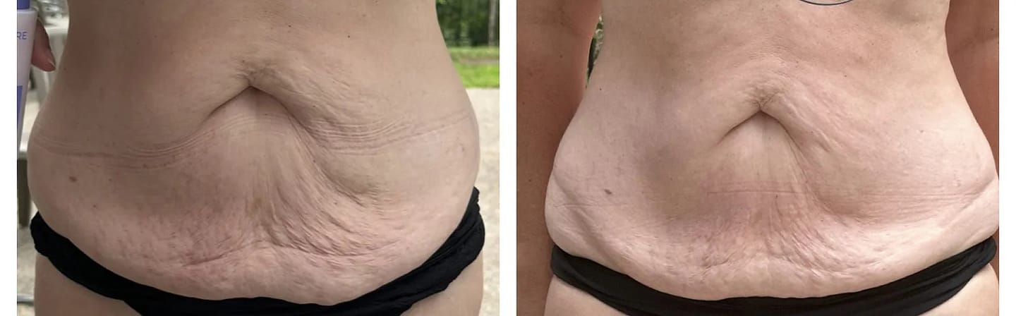 Customer photo review of Corpela® Reafirmante Densificante Piel Abdominal