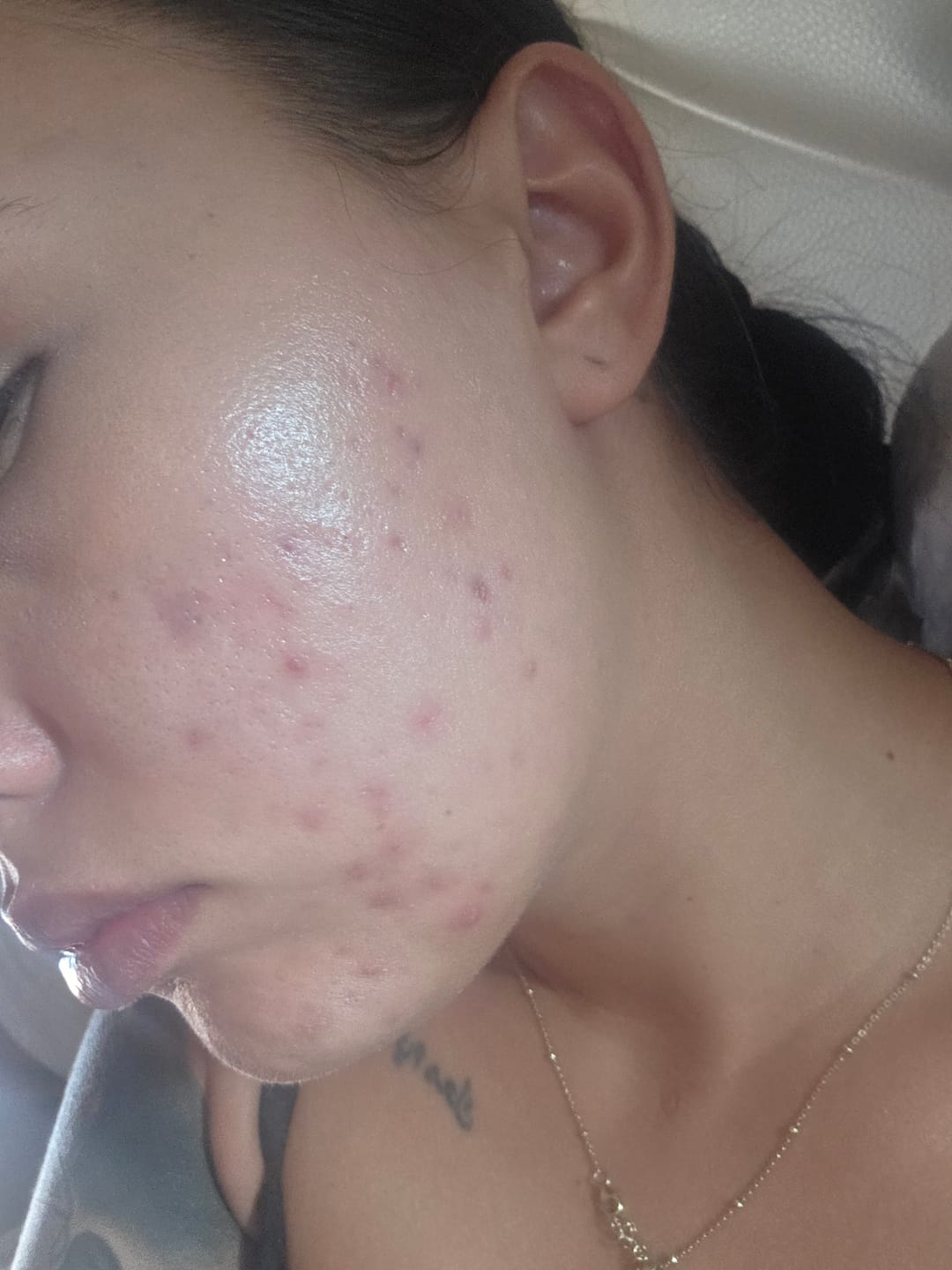 Customer photo review of A CONTROL - ACNÉ HORMONAL & RESISTENCIA A LA INSULINA