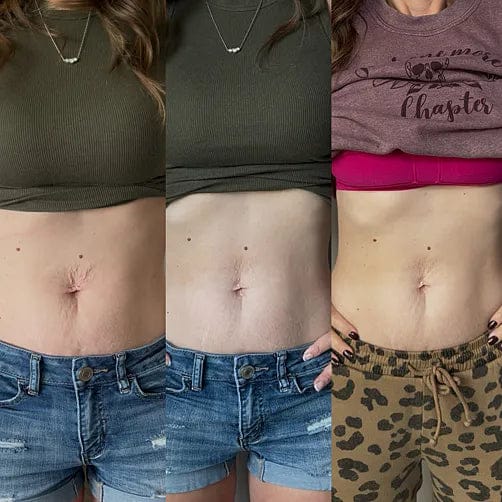 Customer photo review of Corpela® Reafirmante Densificante Piel Abdominal