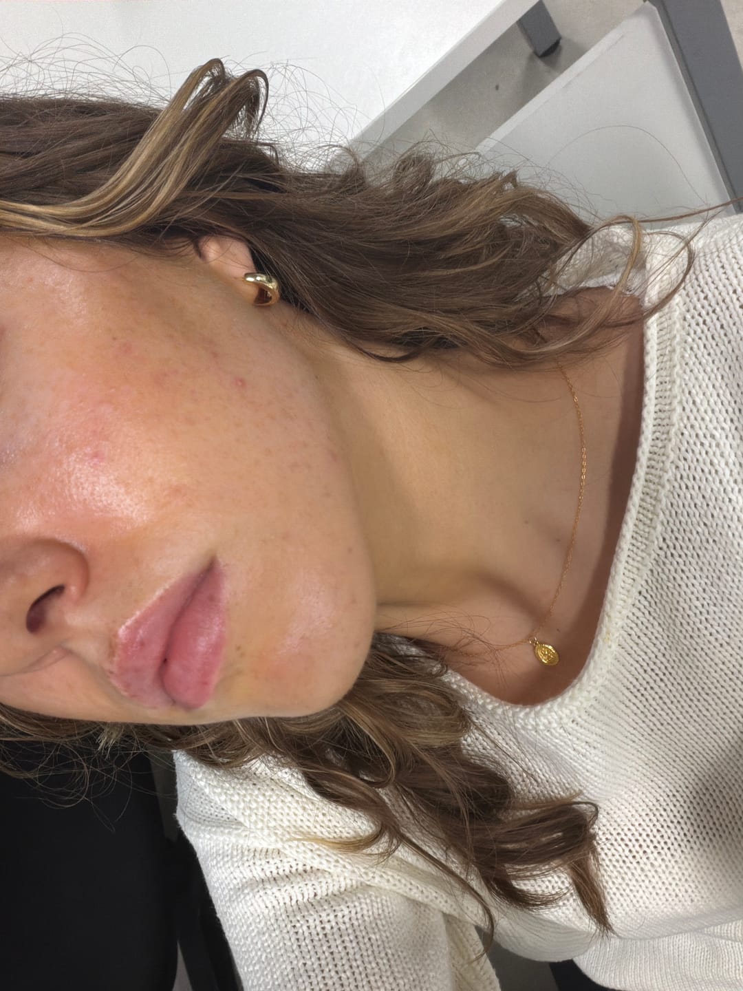 Customer photo review of The Complete System for Acne-Prone Skin