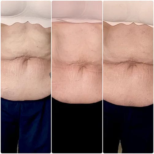 Customer photo review of Corpela® Reafirmante Densificante Piel Abdominal