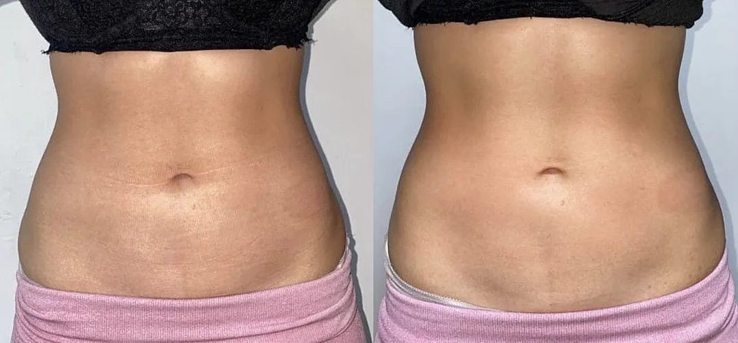 Customer photo review of Corpela® Reafirmante Densificante Piel Abdominal
