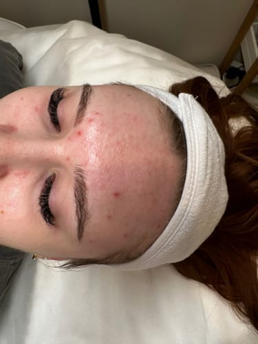 Customer photo review of Dr. Pen M8S Microneedling Pen AU Charger