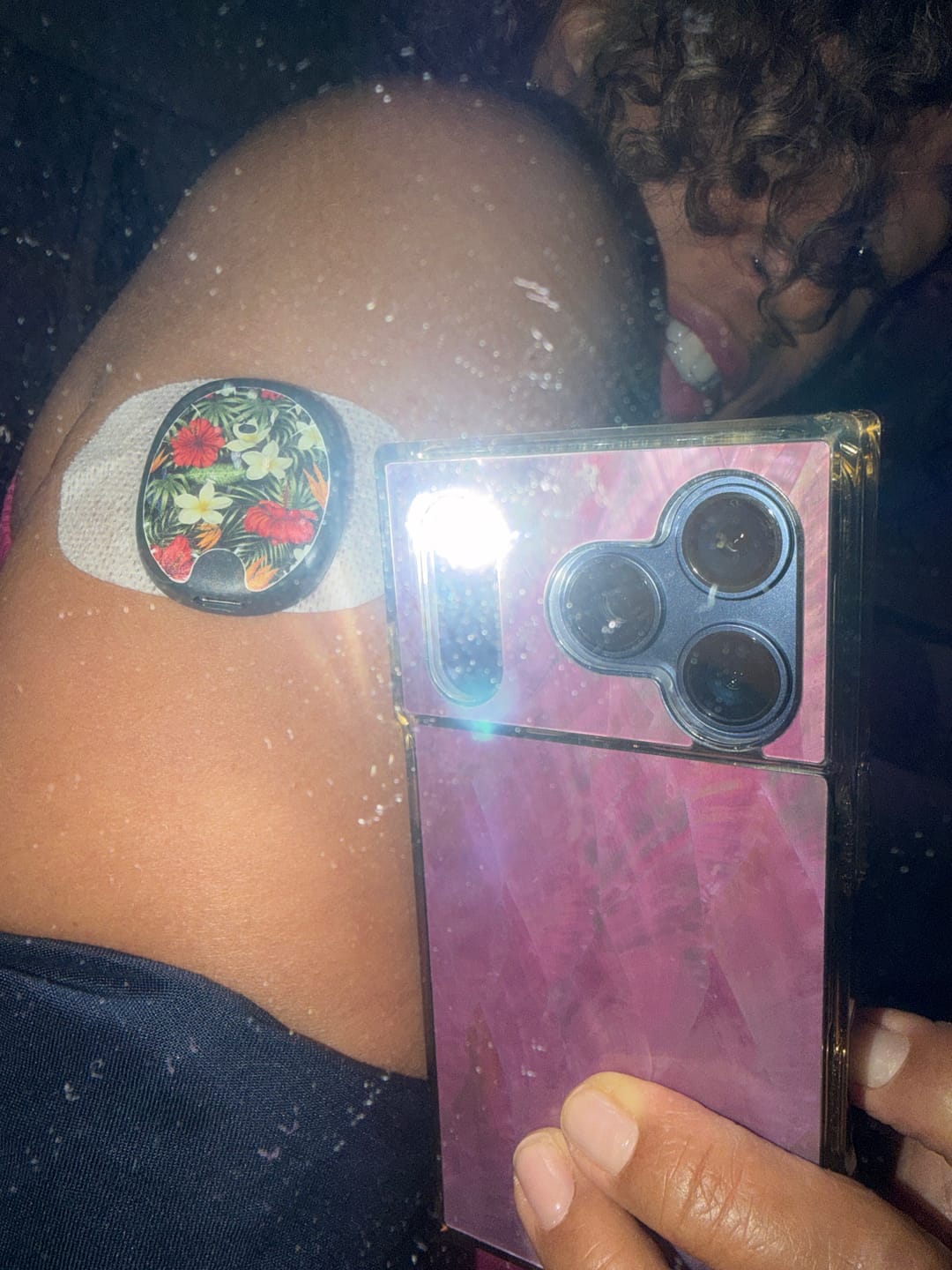 Customer photo review of Eversense CGM Stickers