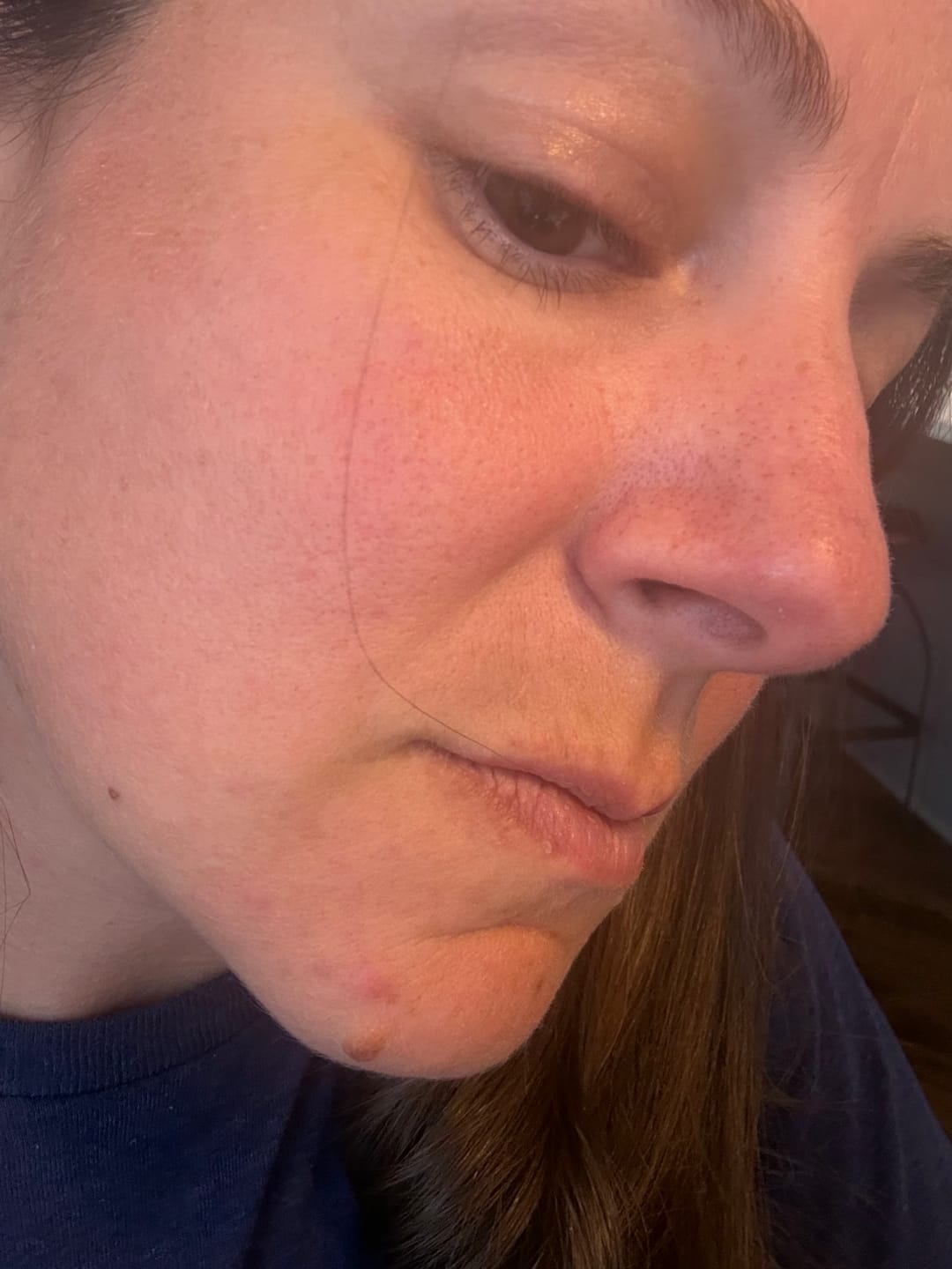 Customer photo review of Kill Acne & Redness Ritual