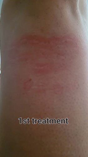 Customer photo review of Dr. Pen M8S Microneedling Pen AU Charger